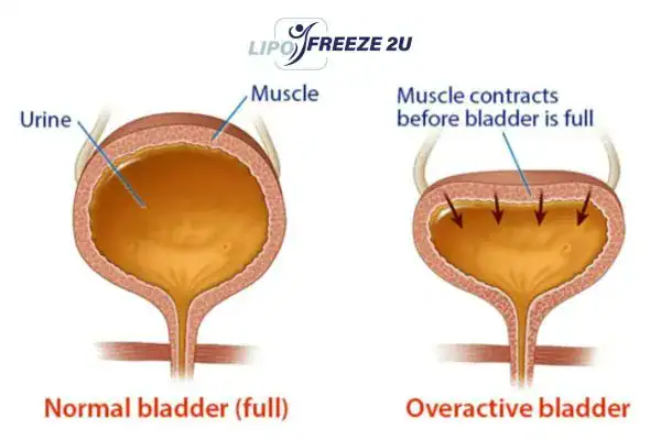 diagram of overactive bladder treatment Crawley