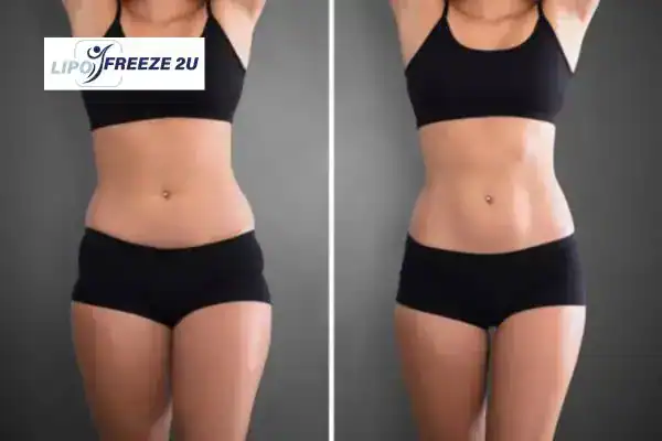 How Can LIPO FREEZE 2U Support Your Post-Pregnancy Body Recovery Crawley?