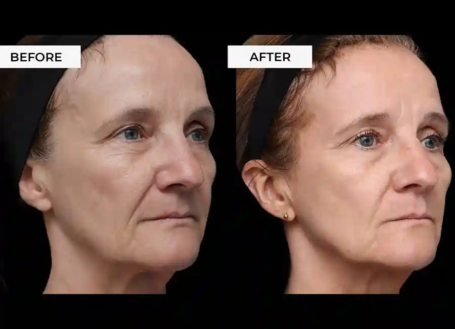 How Many RF Microneedling Sessions Will You Need to See a Difference Crawley?