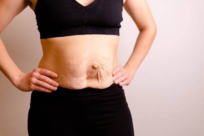Is Surgery Really the Only Way to Repair Diastasis Recti Crawley?