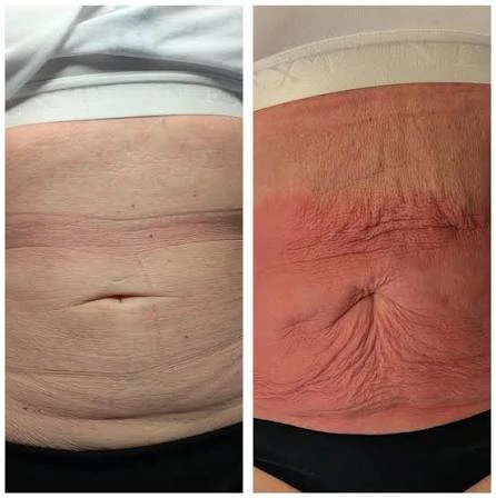 How Does RF Microneedling Improve Crepey, Thin and Uneven Skin Texture Crawley?