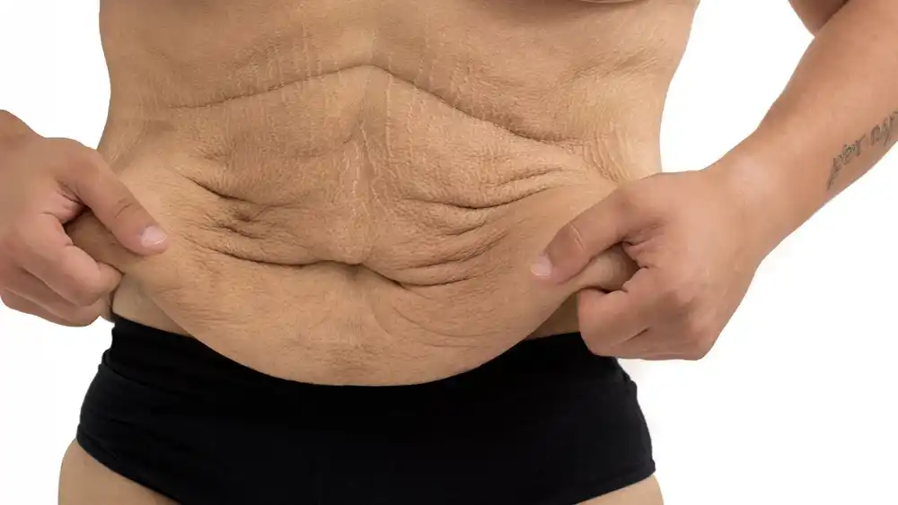 Why Does Weight Loss Medication Leave Some People With Loose or Sagging Skin Crawley?